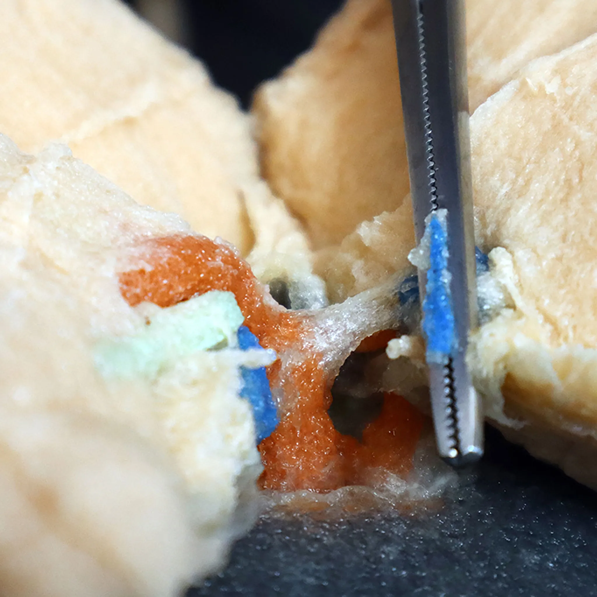 Left Lobectomy Model