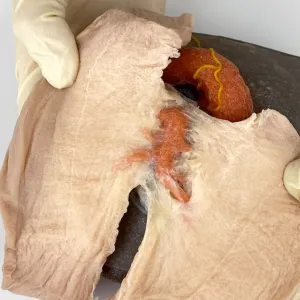Left Lobectomy Model
